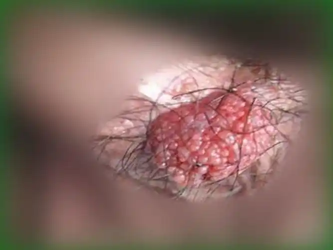 男性尖锐早期症状图片 (32)_有来医生