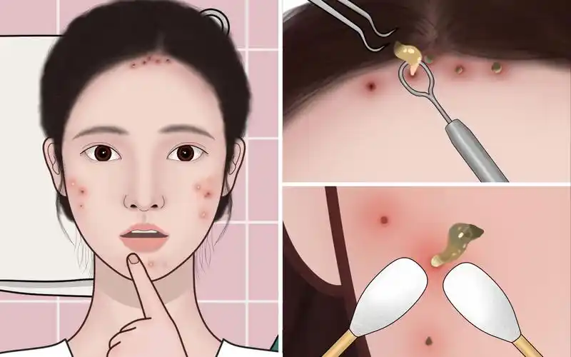 沉浸式清理痘痘,这样去痘干净又解压 | 萌大佬动画