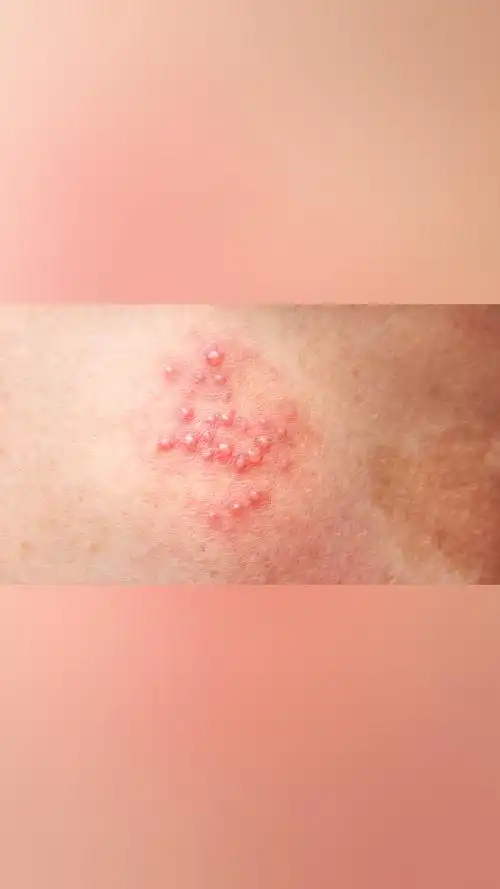 女性患有生殖器疱疹会有哪些麻烦