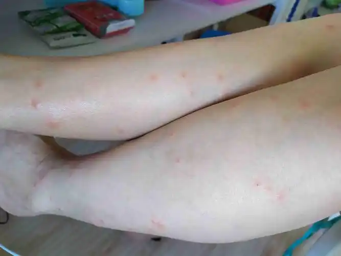 红疙瘩特别痒有图