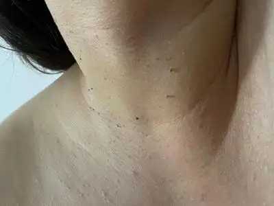 丝状疣的症状和图片 - 有来医生