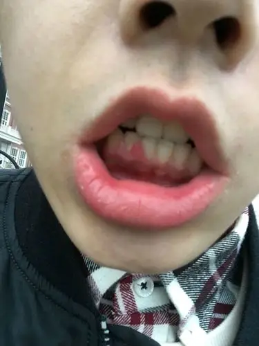 想问问牙龈这是怎么回事