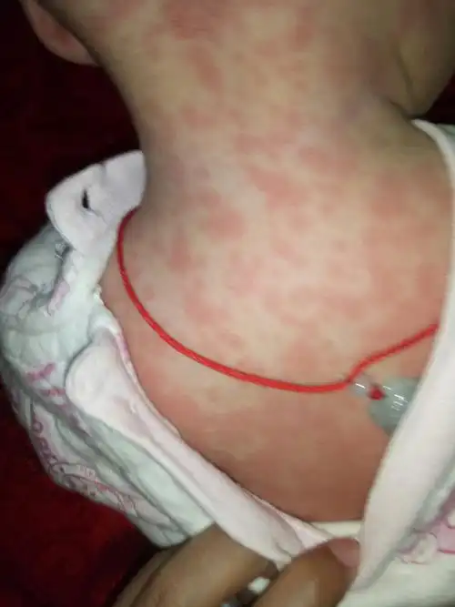 我宝宝是前几天发烧去医院看,医生说退烧后会全身长红点,是这样吗?