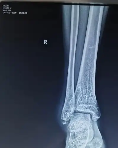 一例腓骨下极撕脱骨折 - 美篇