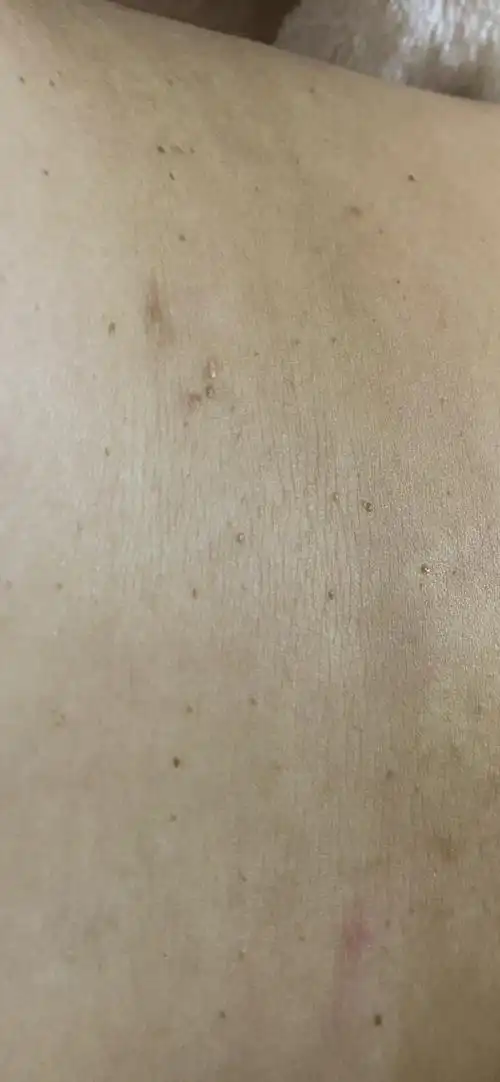 身上扁平疣越来越严重怎么办以前只有几颗现在满肚子都是太难受了