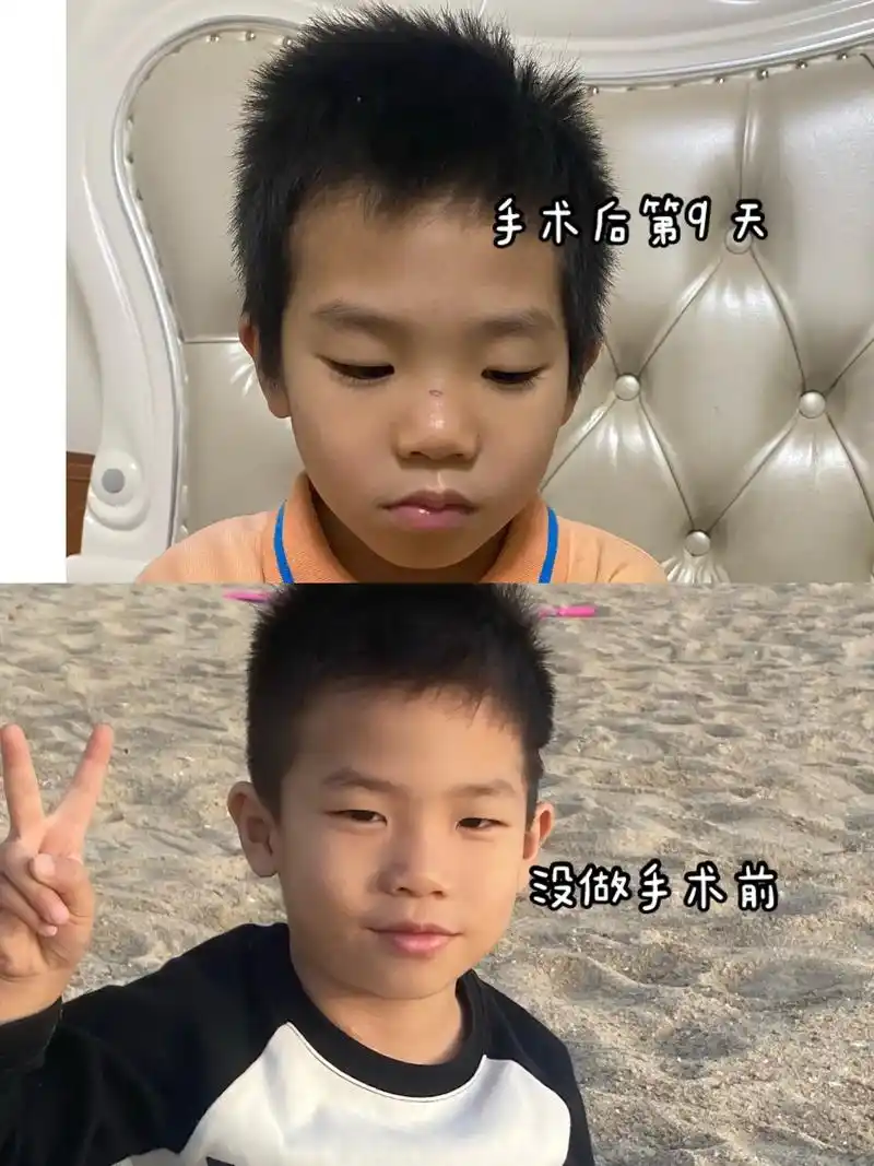 腺样体恢复.做完腺样体扁桃体手术第9天,嘴巴从第3天开始臭, - 抖音