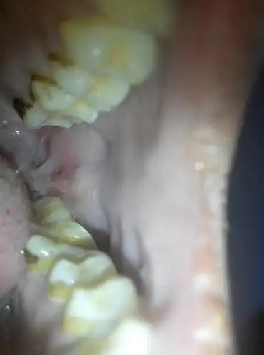 问:口腔内侧肿了一条线,是怎么回事啊