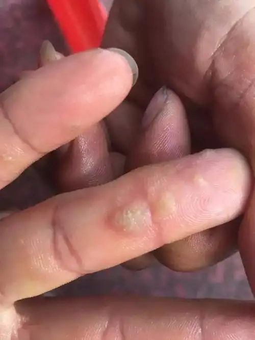 属于什么疣?由没什么有效治疗方案.谢谢!