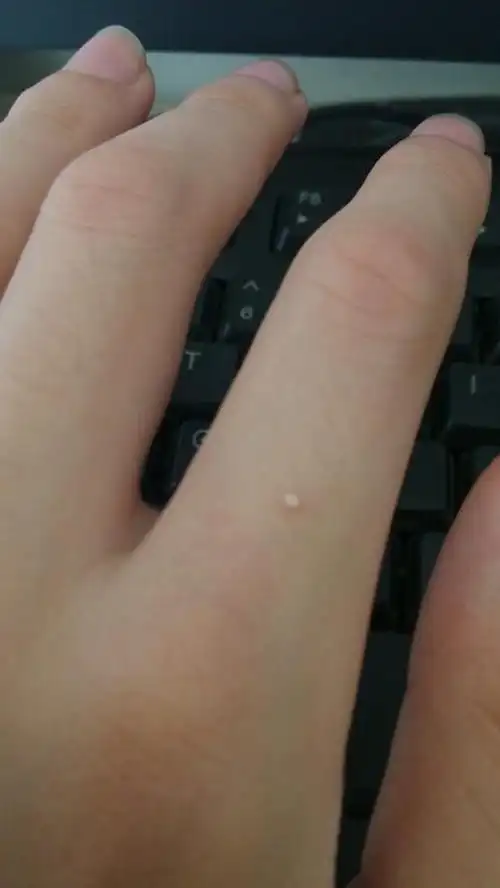 手上起白色小块是什么ltbr