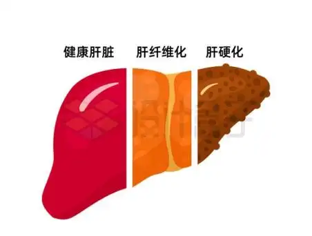 由健康和肝纤维化和肝硬化组成的肝脏7169944矢量图片免抠素材