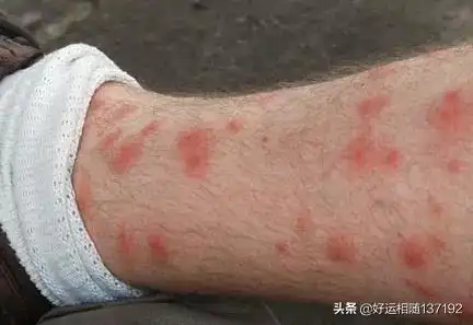 为什么有臭虫臭虫咬人伤口辨认图片