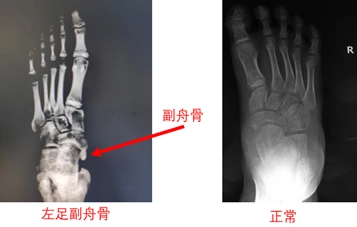 儿童副舟骨_先天性足畸形_介绍_症状表现_治疗方式 - 好大夫在线