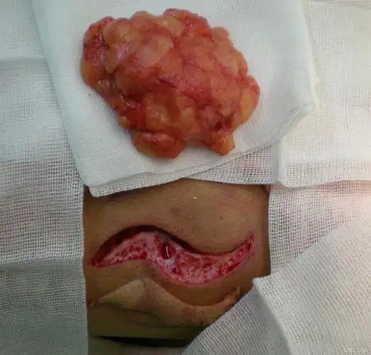 【 资源】背部脂肪瘤切除—真皮瓣填充 bihongda 2010-01-09 20:50