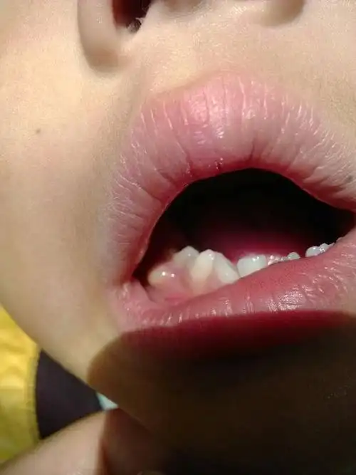 5岁小孩子 牙龈起泡 鼓起挺大的,是怎么回事?经常有,碰到就疼