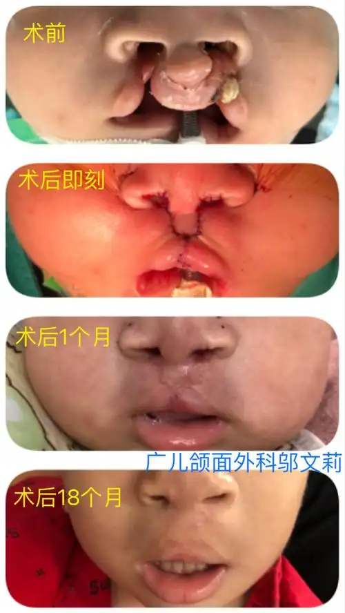 双侧唇腭裂修复_唇腭裂_唇腭裂治疗方式 - 好大夫在线