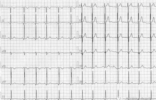 心电图基础病理性q波的鉴别诊断
