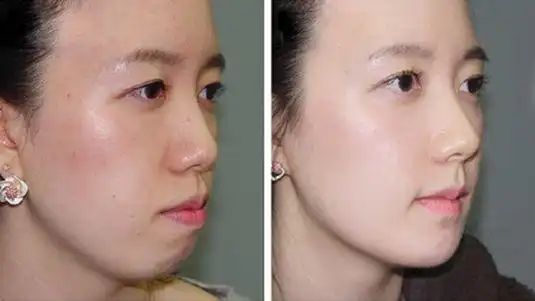 下巴矫正_成功案例_无锡美联臣整形美容医院官网