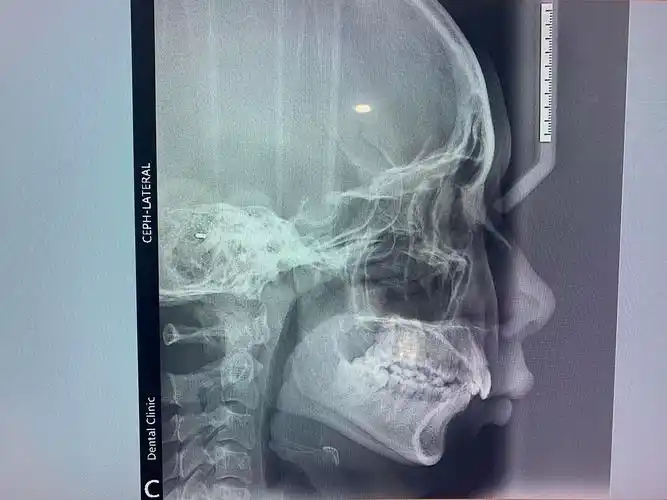 骨性 牙性嘴凸 医生建议我箍牙 正颌!