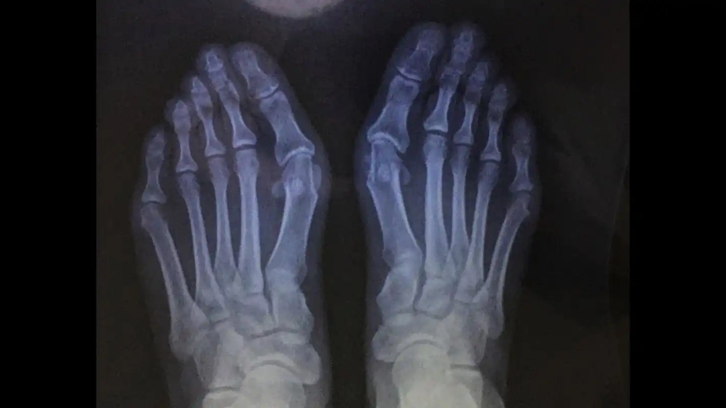 因为拇外翻的根本原因是第一跖骨内翻,与外翻的第