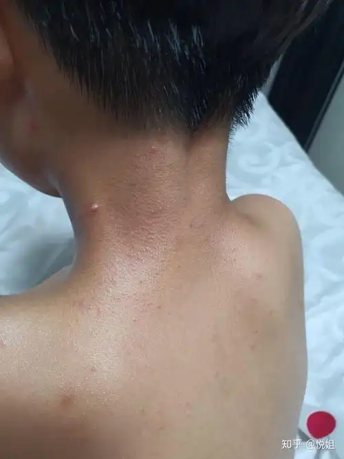 一岁宝宝传染性软疣如何治疗