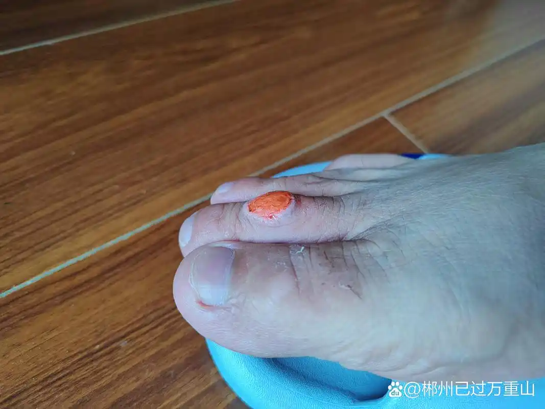 脚上长了个鸡眼,去药店买了一盒鸡眼膏,花了我25元,一盒贴完了还是