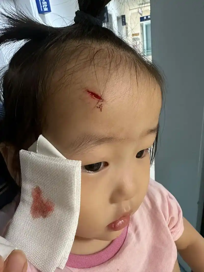 闺女骑车不小心摔了一下  磕到头上一个伤口  真是个勇敢的宝 - 抖音