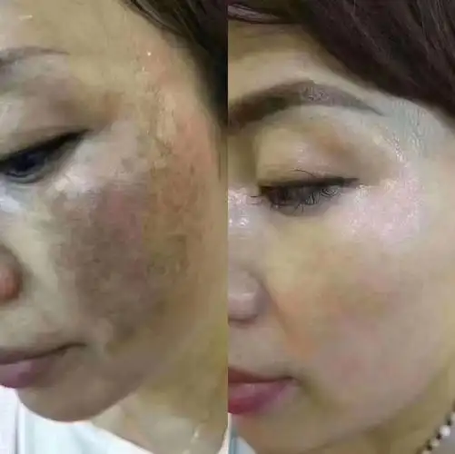 祛斑黄褐斑,美白,补水素颜照