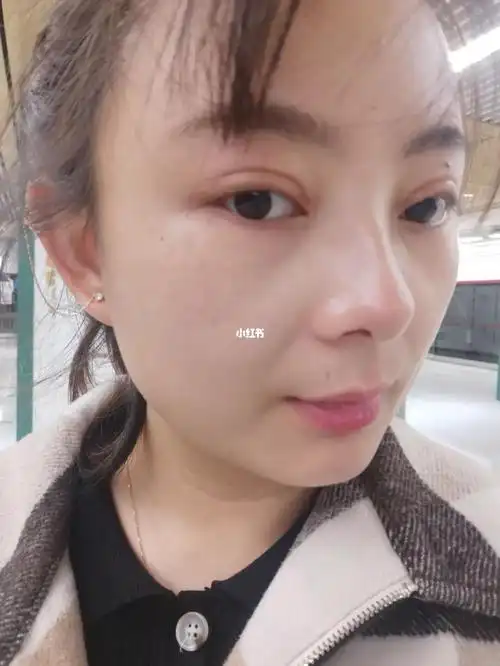 全切双眼皮_双眼皮手术_双眼皮_美妆_医美整形