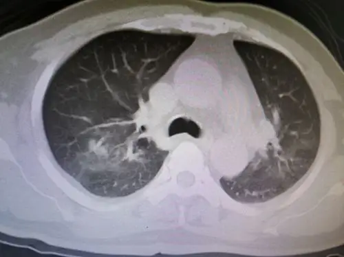 没有任何症状的肺结核