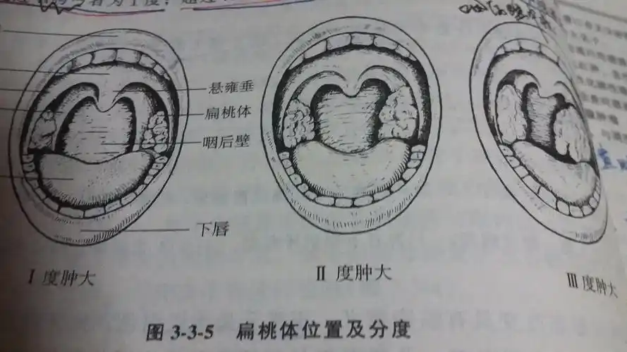 扁桃体肿大分度小常识