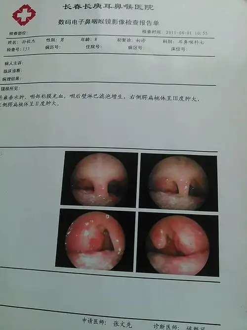 男孩六岁半腺样体肥大约占后鼻孔三之二,会厌无红肿抬举良好双侧声带