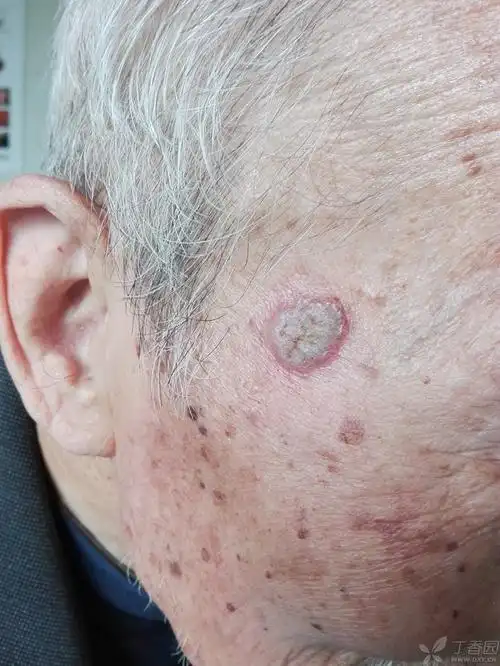 【请教】老人面部疣状斑片两年 - 皮肤与性传播疾病讨论版 -丁香园论
