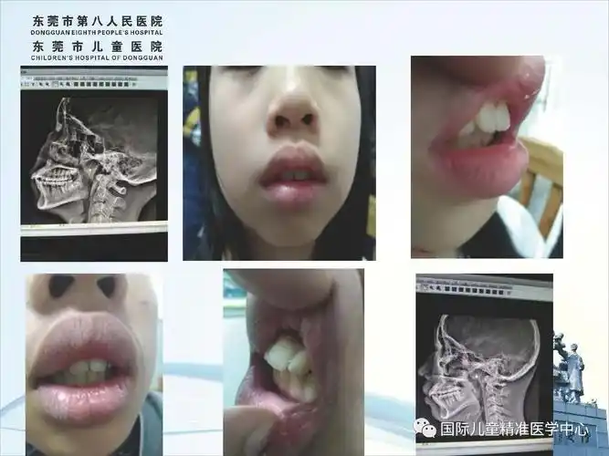 儿童腺样体肥大