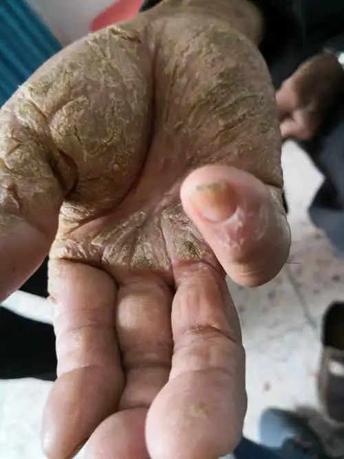 双手掌,双脚掌,对称性皲裂.请问这是什么皮肤病