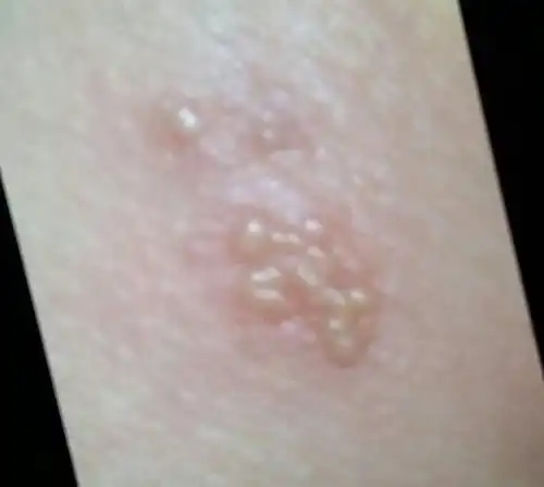 屁股上长了一个团,好多小水泡,怎么了?
