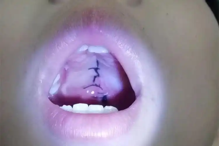 9岁女孩腭部"缺块肉",这种情况该咋办?