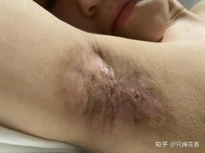 腋下微创手术血泪经验千万不要做