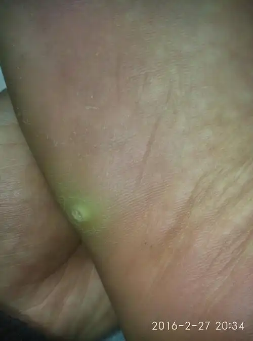 脚底长了一个小洞,半年前就痛,当时以为是被木刺扎了,没太在意,今天一