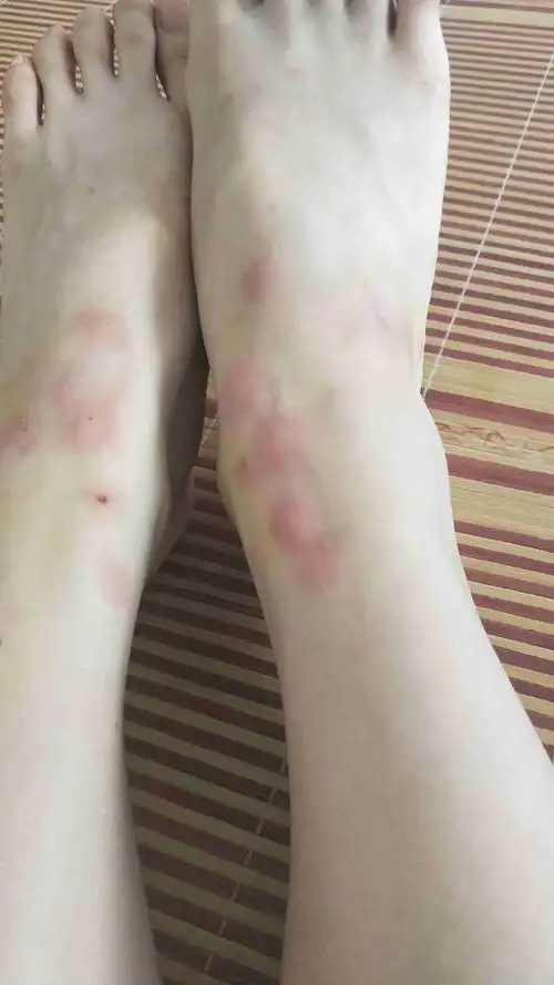 我想问一下我这个是跳蚤咬的吗,要怎么消掉(很痒)