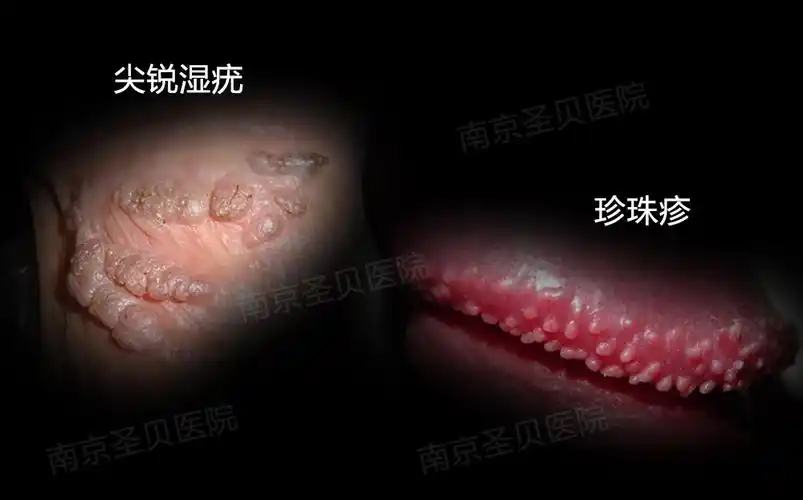 与尖锐湿疣的处理方式也不一样,由于珍珠疹是正常组织,对人体没有危害