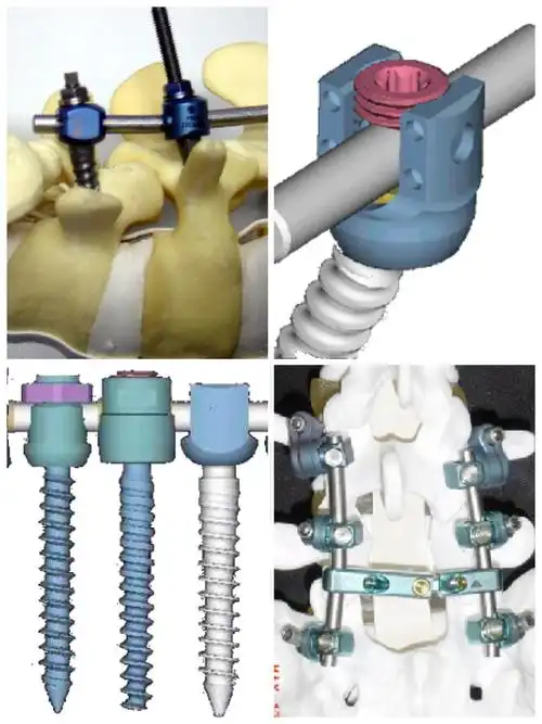 所需的椎弓根钉