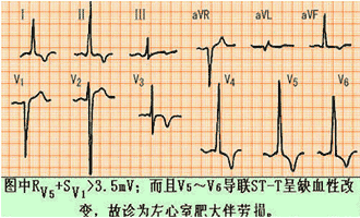 5mv   2.心电轴右偏≥90°(重症可> 110°).  2.可出现心电轴左偏.