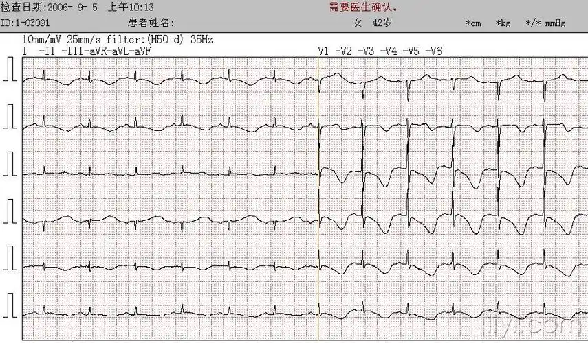 尼加拉瓜(niagara)大瀑布式巨型t波 - 心电图脑电图专业讨论版 - 爱爱