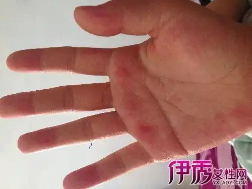 红怎么办 女宝宝小便处两侧发红怎么办