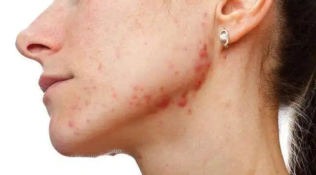 你是不是螨虫脸5点对照自测螨虫脸3方法净除螨