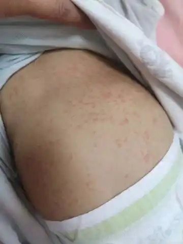 白天突然发烧38-39度,3天后退烧了,接着就全身密密麻麻起疹子了,都2天