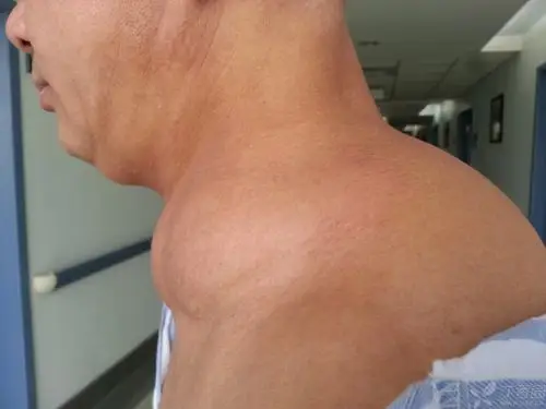 【共享】2014年做的2例颈部对称性脂肪瘤病