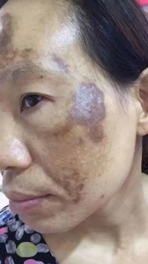 [爱心]严重的铅汞斑,一次的效果就这么好[强]!理肤之秀牛逼[强]