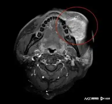 新疗法兼顾患者健康与尊严|手术|肿瘤|出血|口腔癌|胆囊结石_网易订阅