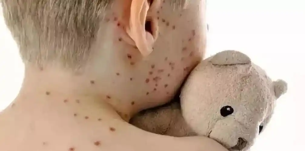 远离风疹,预防为主